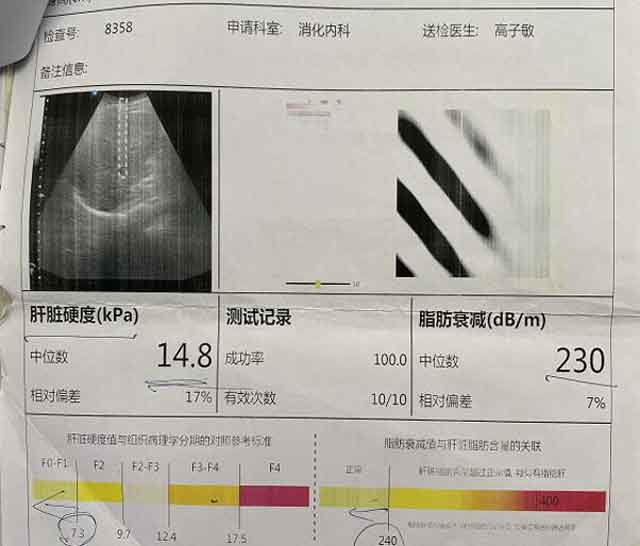 郑州专业看肝硬化医院?郑州肝硬化治疗医院在哪里