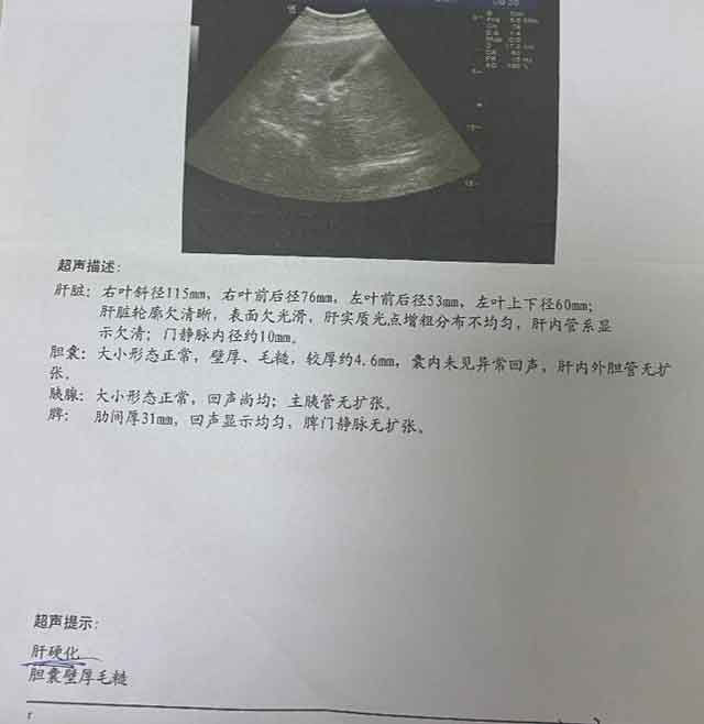 郑州专业看肝硬化医院?郑州肝硬化治疗医院在哪里