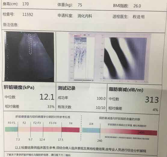 郑州那家医院看肝硬化好?郑州治疗肝硬化好的医院
