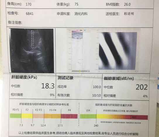 郑州那家医院看肝硬化好?郑州治疗肝硬化好的医院