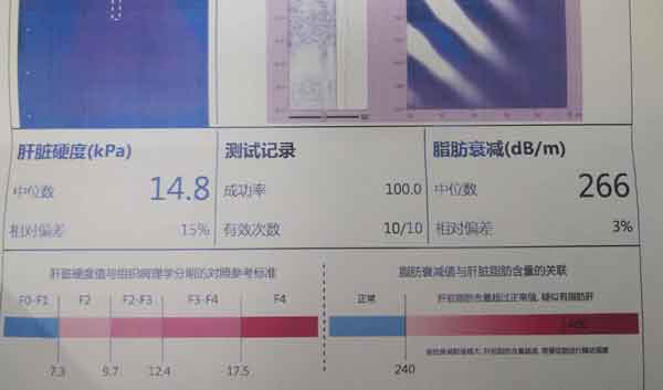河南现在哪个医院治疗肝硬化较好