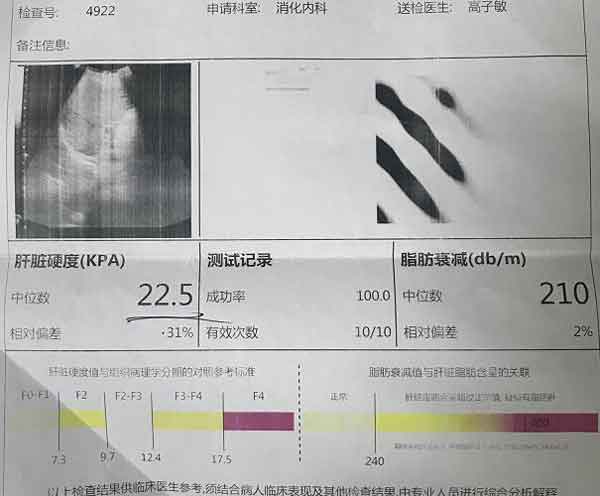 河南郑州市哪个肝病医院治疗肝硬化好