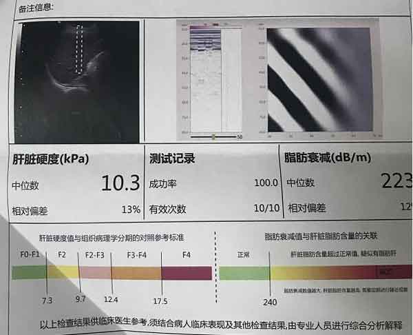 河南郑州市哪个肝病医院治疗肝硬化好