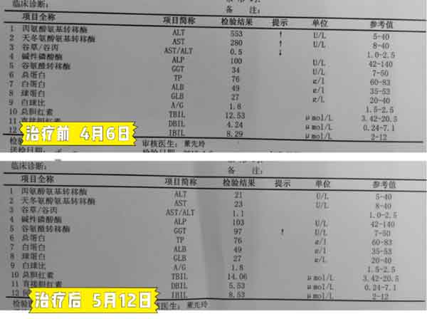 郑州哪个是治疗乙肝大三阳的医院