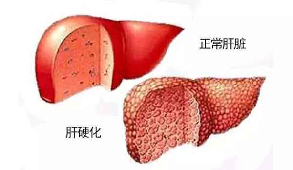 郑州哪个是治疗乙肝大三阳的医院