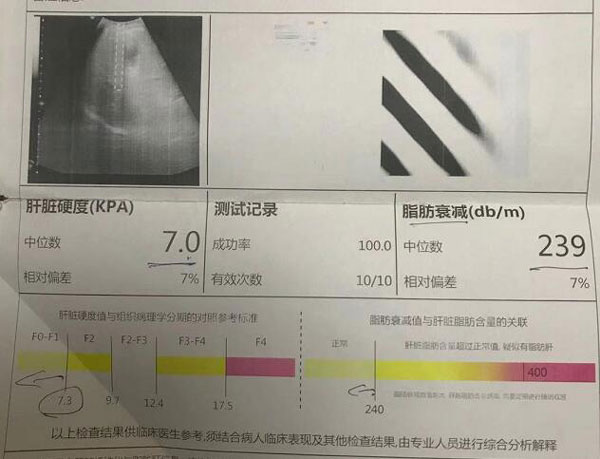 【庄淑英主任案例分享】六次软肝治疗,肝弹检查16.9恢复至7.0