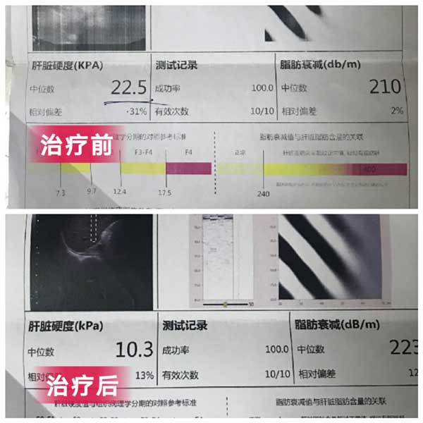 郑州看乙肝的医院哪家好